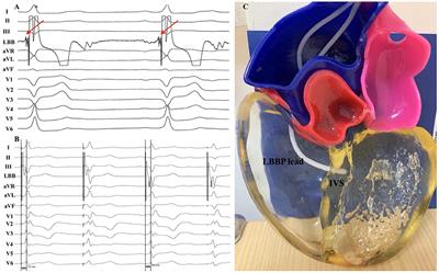 Case report: Three-dimensional printing as an educational tool for optimal lead positioning to left bundle branch pacing